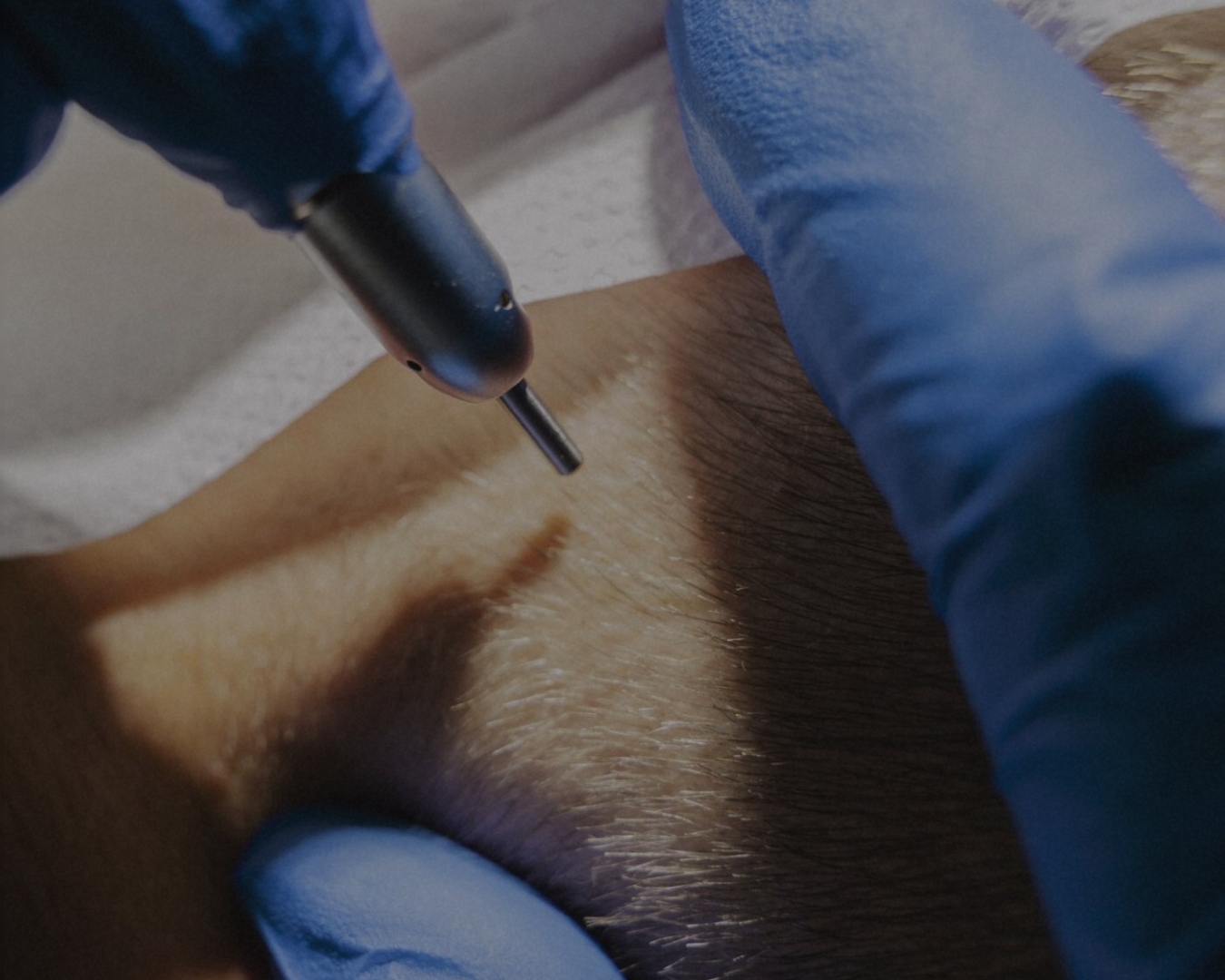 Die PRP-Behandlung gegen Haarausfall: Ein Hoffnungsschimmer für volles, gesundes Haar