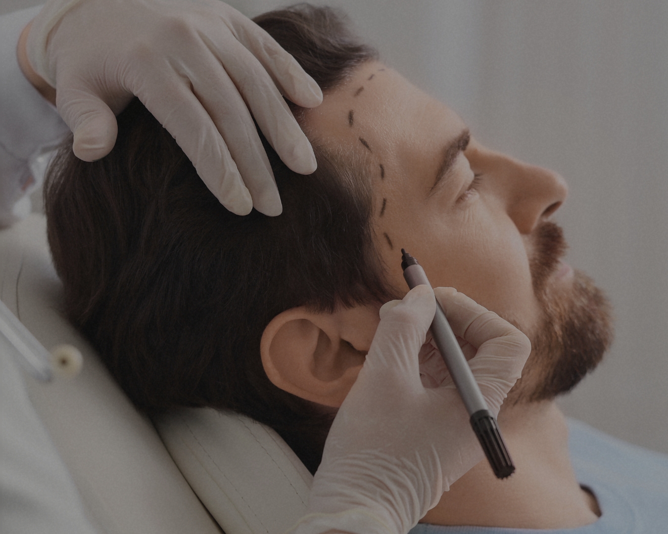 Die FUE-Methode zur Haartransplantation - Alles, was Sie wissen müssen