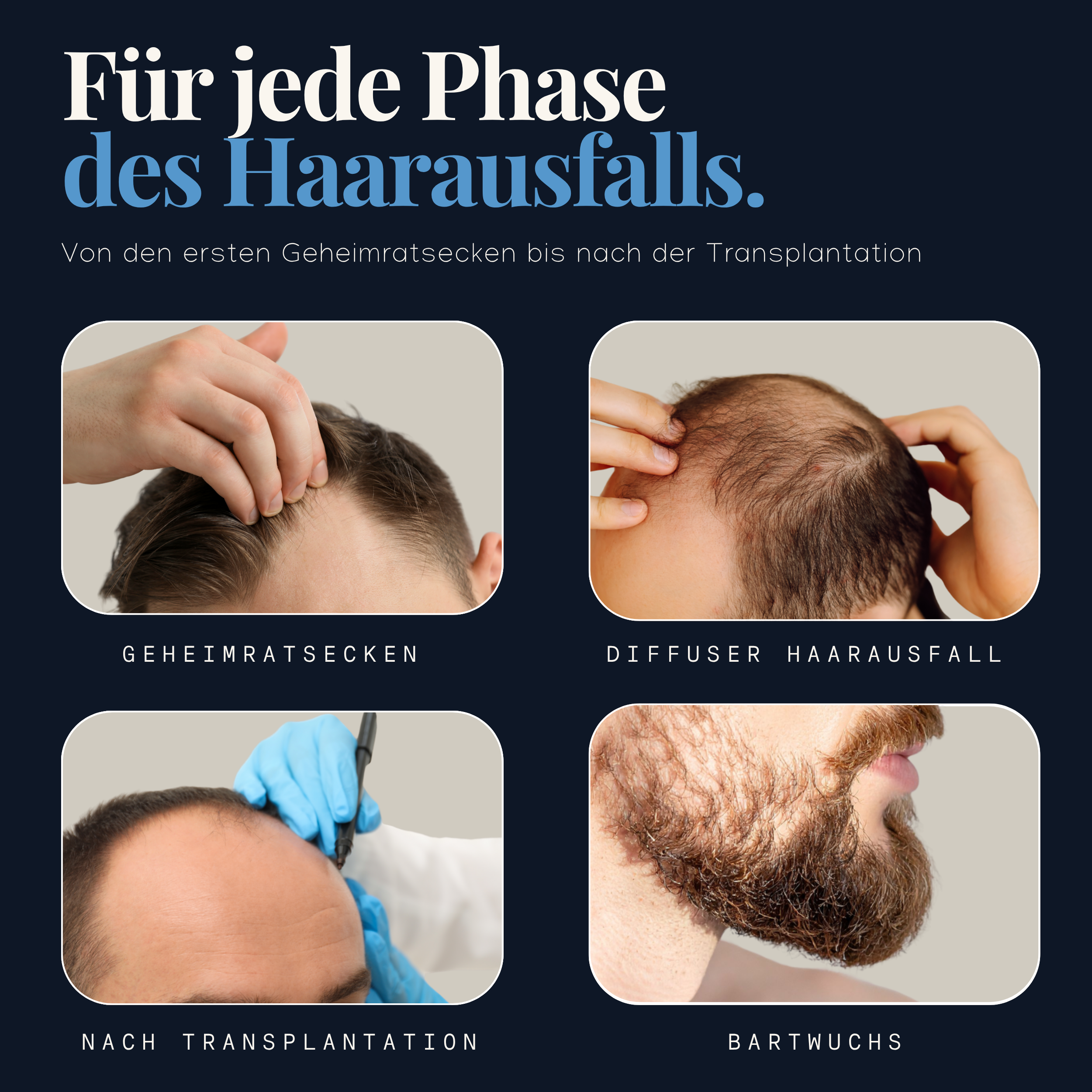 Hairforte Spray 3% Procapil pour Homme – Soin du Cuir Chevelu, 60 ml